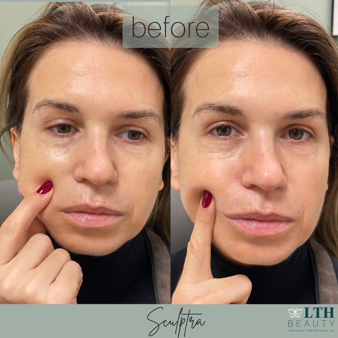 Sculptra patient — before photo showing cheek volume