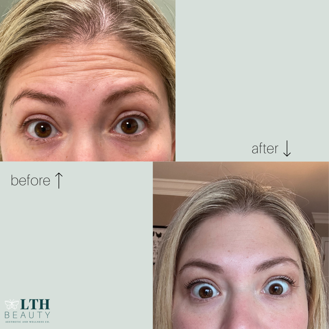 Before and after neurotoxin treatment — forehead wrinkles reduced
