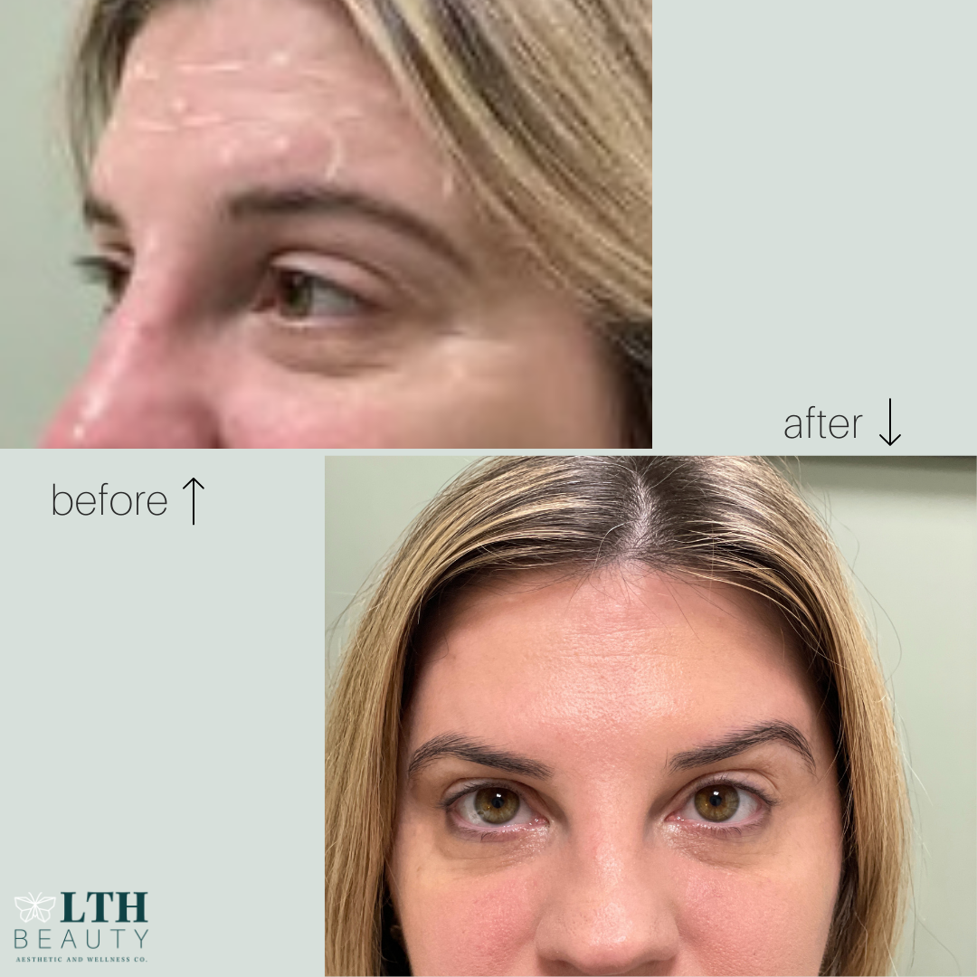 Before and after neurotoxin treatment — crow's feet area