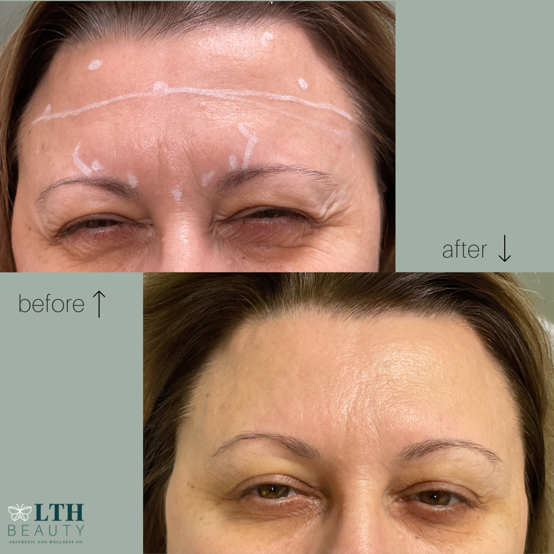 Before and after neurotoxin treatment — frown lines (glabellar) smoothed