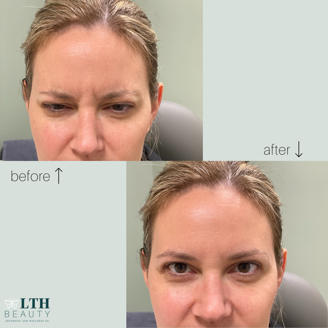 Before and after neurotoxin treatment — frown lines reduced
