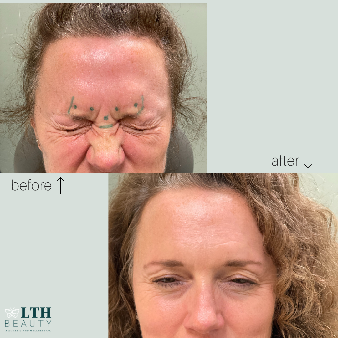 Before and after neurotoxin treatment — bunny lines and glabellar area