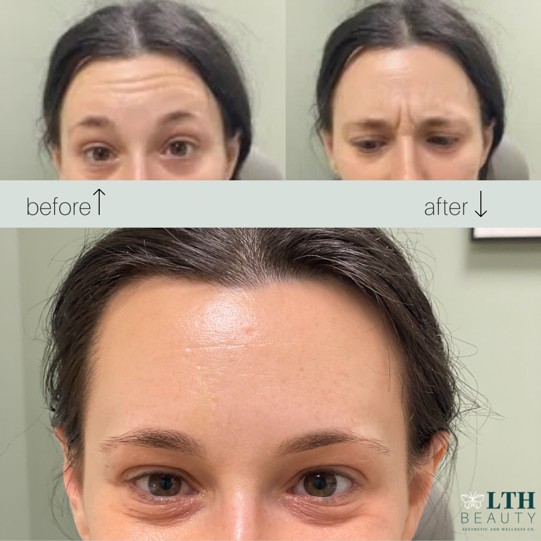Before and after neurotoxin treatment — forehead lines smoothed